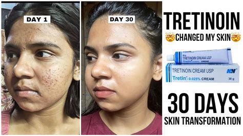 trans crema|Tretinoin Cream: Skin Benefits, How to Use, Side Effects